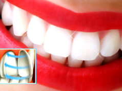 Качественные виниры — залог безупречной улыбки