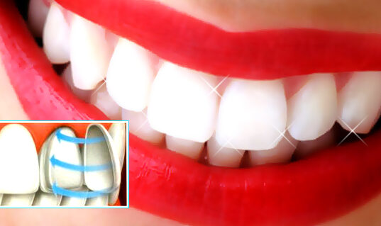 Качественные виниры — залог безупречной улыбки
