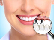 Имплантация зубов-сделай красивой свою улыбку