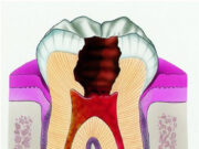 Хронический периодонтит: причины, диагностика и лечение