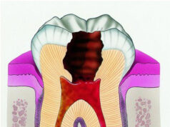 Хронический периодонтит: причины, диагностика и лечение