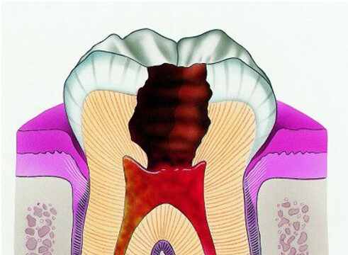 Хронический периодонтит: причины, диагностика и лечение